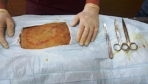 BÜYÜKŞEHİR’DEN BİR İLK: DOKU NAKLİ