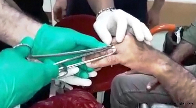 PARMAĞA SIKIŞAN YÜZÜK KESİLEREK ÇIKARILDI