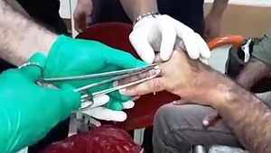 PARMAĞA SIKIŞAN YÜZÜK KESİLEREK ÇIKARILDI 