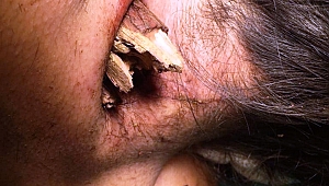 BOYNUNA 30 SANTİMLİK KAZIK SAPLANAN HASTA SAĞLIĞINA KAVUŞTU!