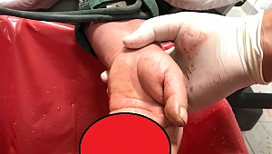 Elini Kıyma Makinesine Kaptıran Kadının Parmakları Koptu