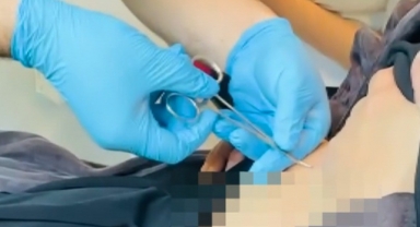 Hastaneye Gitti, Karnına Yapışan Kene ile Karşılaştı