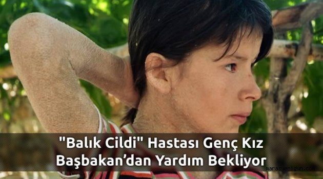 Balık Cildi" Hastası Genç Kız Başbakan’dan Yardım Bekliyor